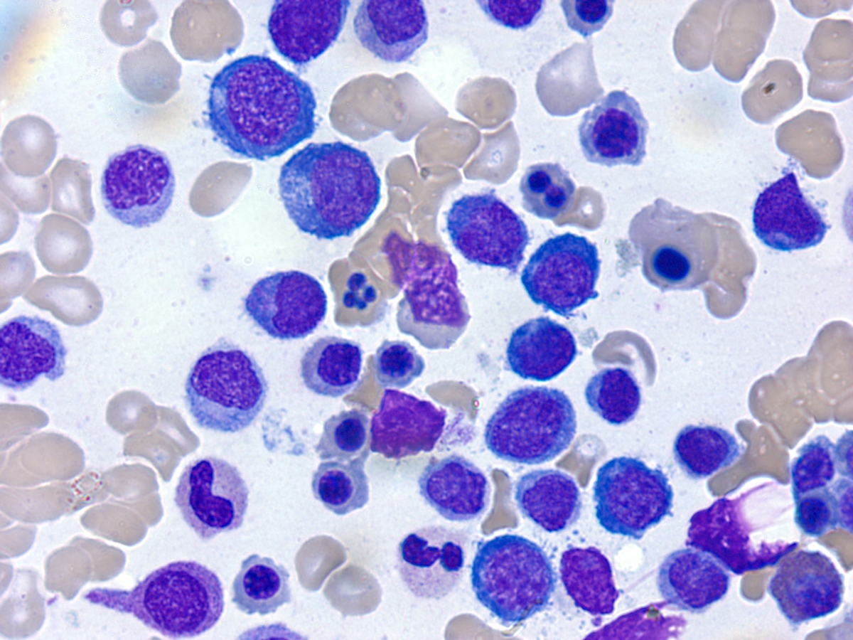 Bone marrow aspirate (Wright stain): Erythroid dyspoeisis and increased blasts
